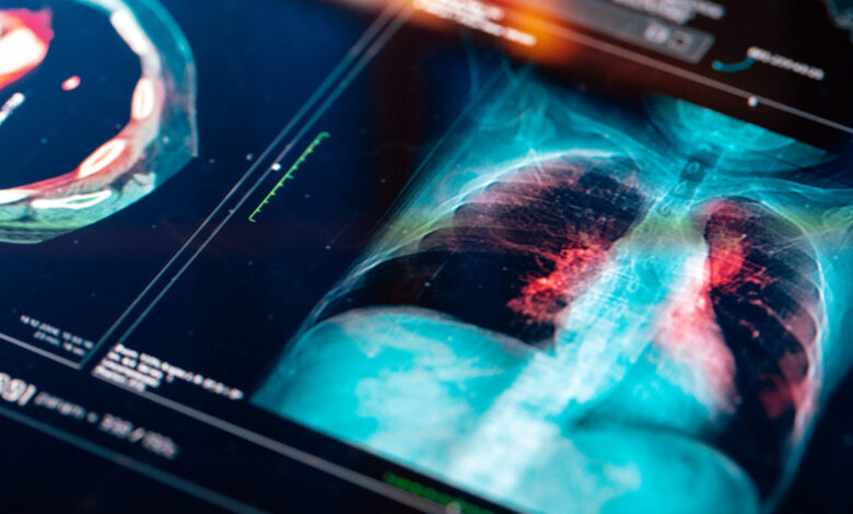 Medical MRI  Scan on digital screen health cancer lung doctor